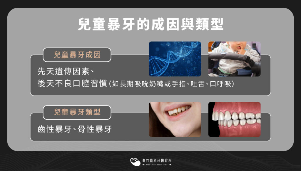 兒童暴牙的成因與類型