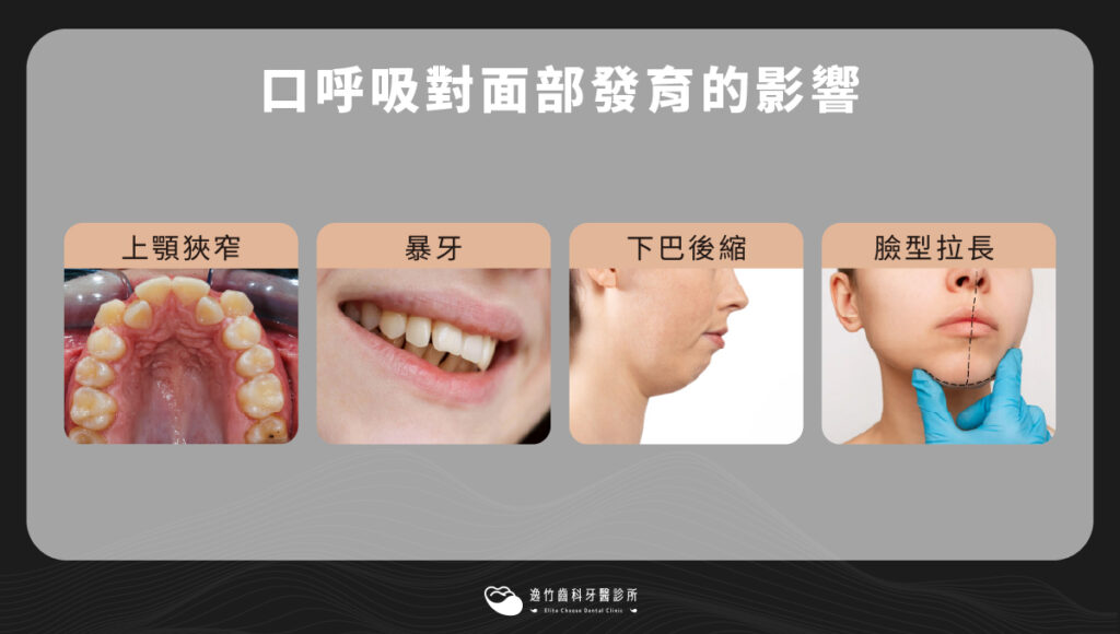 口呼吸對面部發育的影響:上顎狹窄、暴牙、下巴後縮、臉型拉長