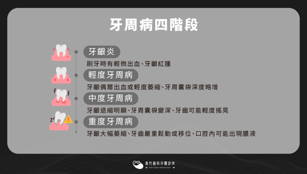 牙周病四階段